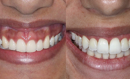 sorriso-gengival-capa