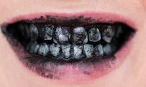 Harmonização Orofacial vai além do sorriso perfeito 5 carvão ativado clareamento