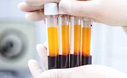 PRP e PRF na Odontologia