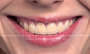 Digital Smile Design