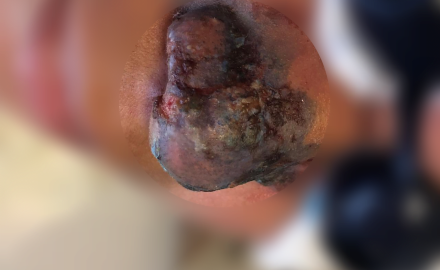 necrose editado3 f316d055