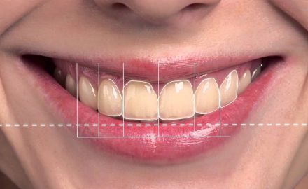 Digital Smile Design